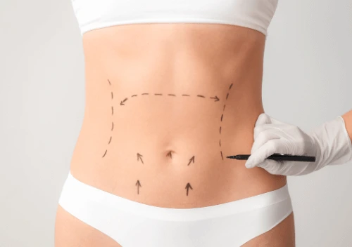 Imagem Exemplo de Abdominoplastia