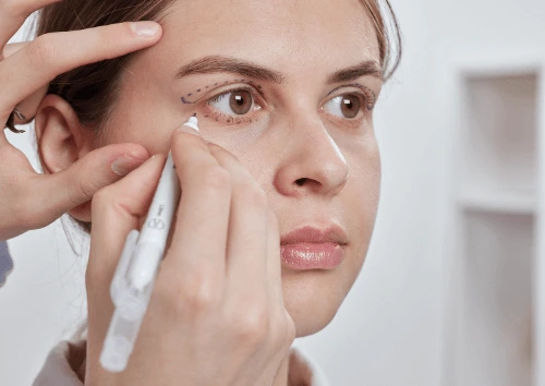 Imagem Exemplo de Blefaroplastia