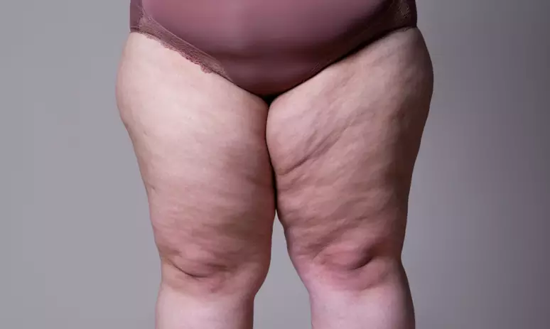 Imagem Exemplo de ninfoplastia