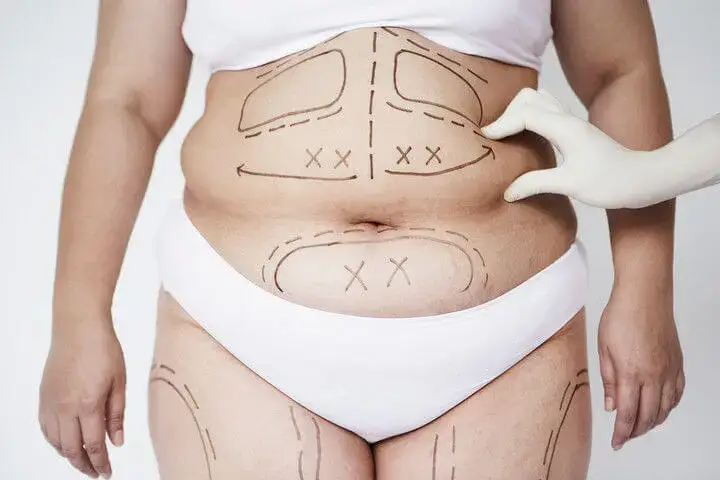 Imagem Exemplo de ninfoplastia